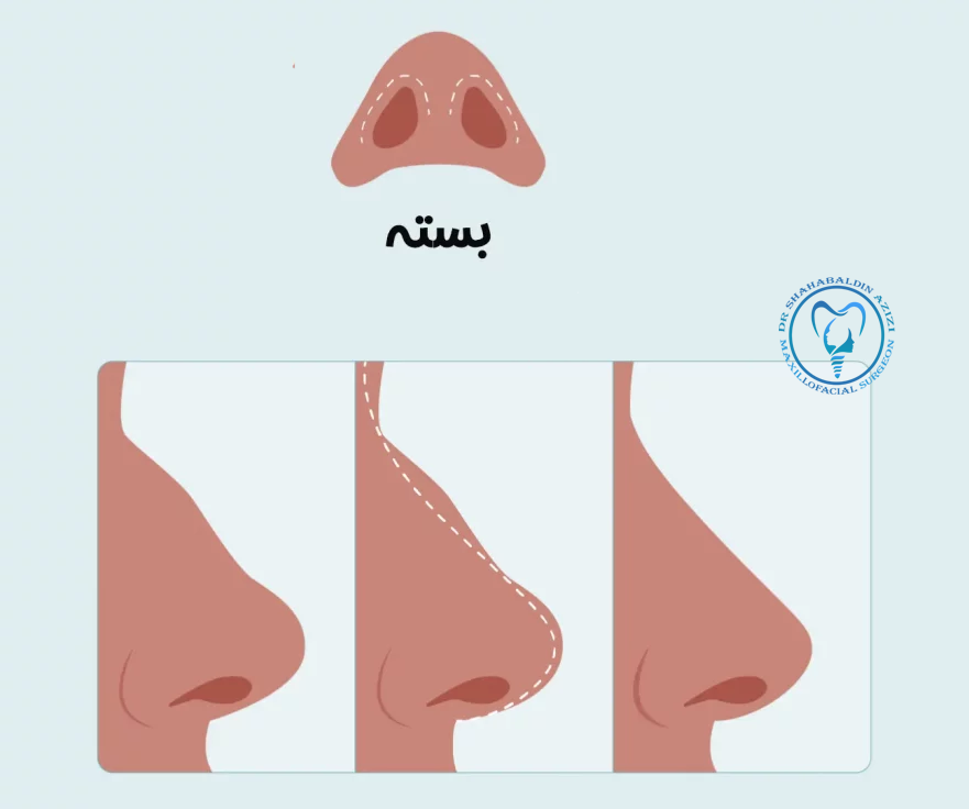 جراحی بینی بسته