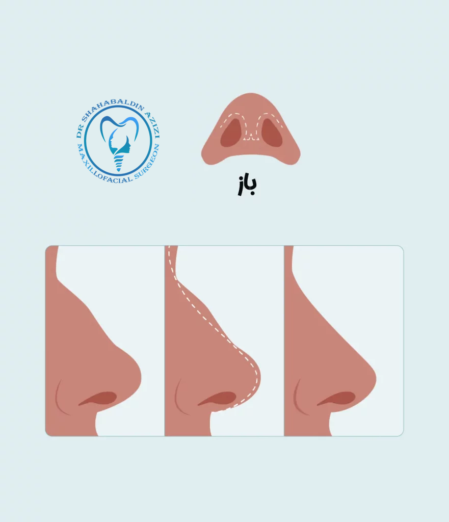 جراحی بینی باز