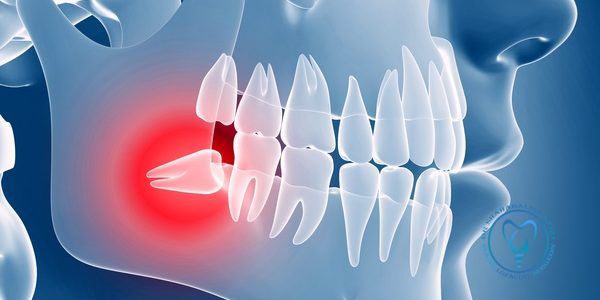 جراحی دندان عقل روی عصب