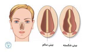 علائم بینی شکسته