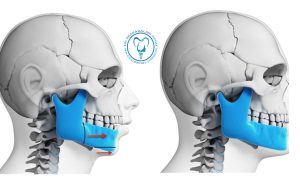 جراحی اصلاح فک پایین