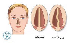 بینی شکسته