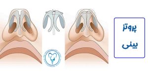پروتز بینی چیست