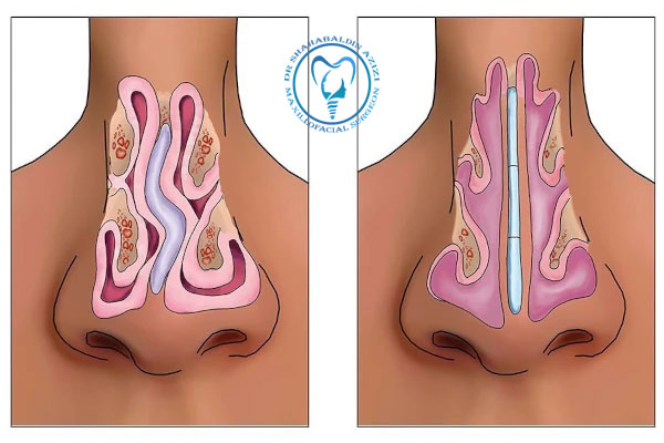 تفاوت عمل بینی با رینوپلاستی