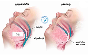 درمان آپنه انسدادی خواب