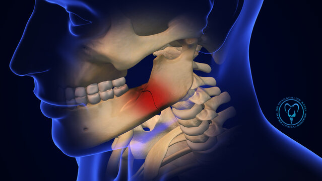 درمان شکستگی فک بدون برش