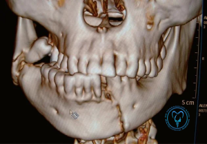 درمان شکستگی فک با روش غیر جراحی