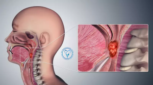 علائم سرطان گلو