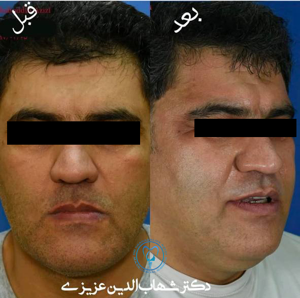جراحی فک در افراد مسن