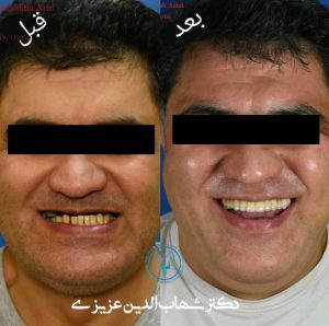 جراحی فک برای افراد مسن