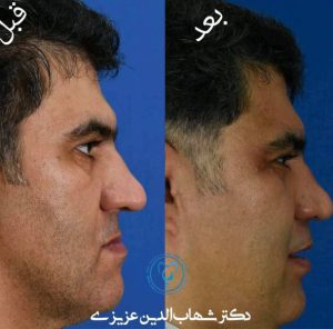 جراحی فک در سن بالا