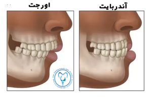 مشکلات شدید فکی