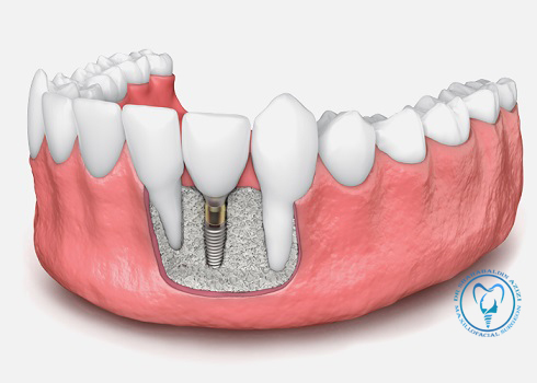 پیوند استخوان از خلف فک پایین