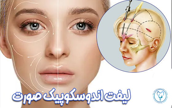 لیفت اندوسکوپیک صورت