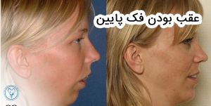درمان عقب بودن فک پایین