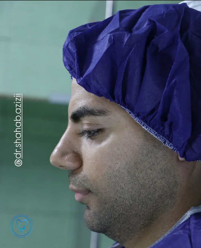 جراحی فک پایین عقب رفته