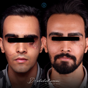 جراحی فک بدون برش
