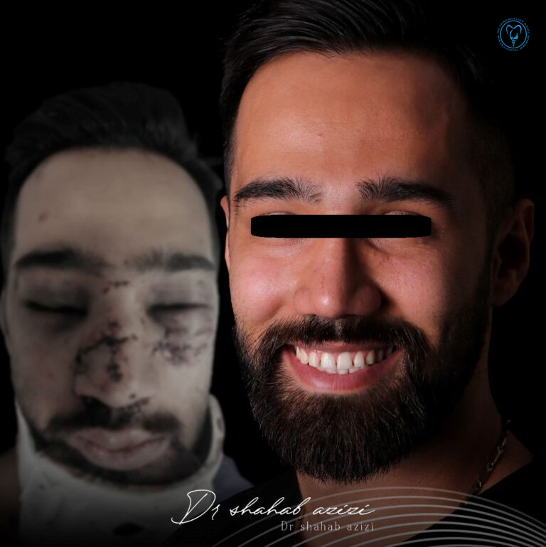 جراحی شکستگی فک و صورت بدون برش روی صورت