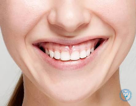 جراحی لبخند لثه ای