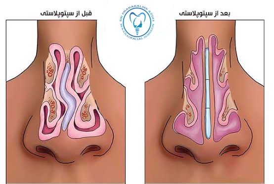 سپتوپلاستی و جراحی پولیپ بینی