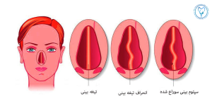 عمل سپتوپلاستی