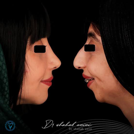 جراحی همزمان فک و چانه