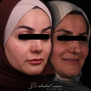 بلفاروپلاستی پلک بالا