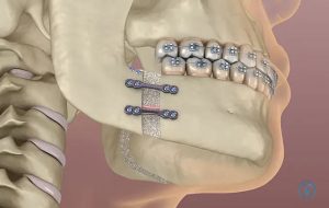 ارتودنسی قبل از جراحی فک