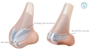 اصلاح افتادگی بینی