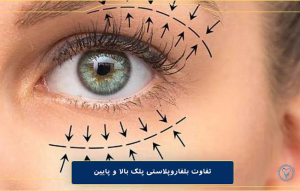 تفاوت بلفاروپلاستی بالا و پایین