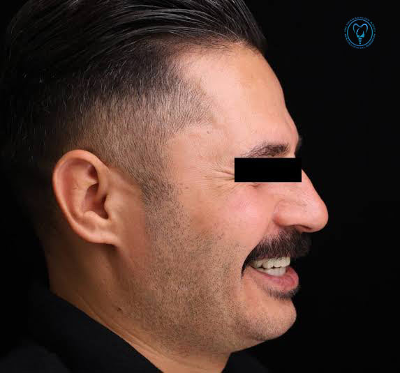 جراحی بایمکس