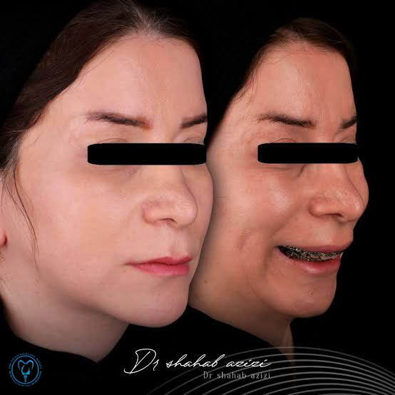 تفاوت جراحی فک و جراحی چانه