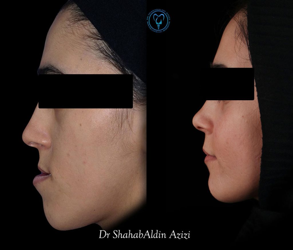 جنیوپلاستی و پروتز چانه