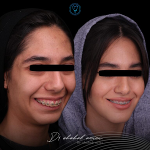 بهترین سن جراحی فک برای دختران