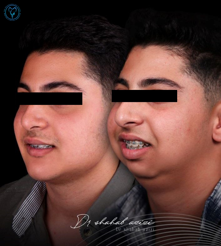 تعویض مفصل فک