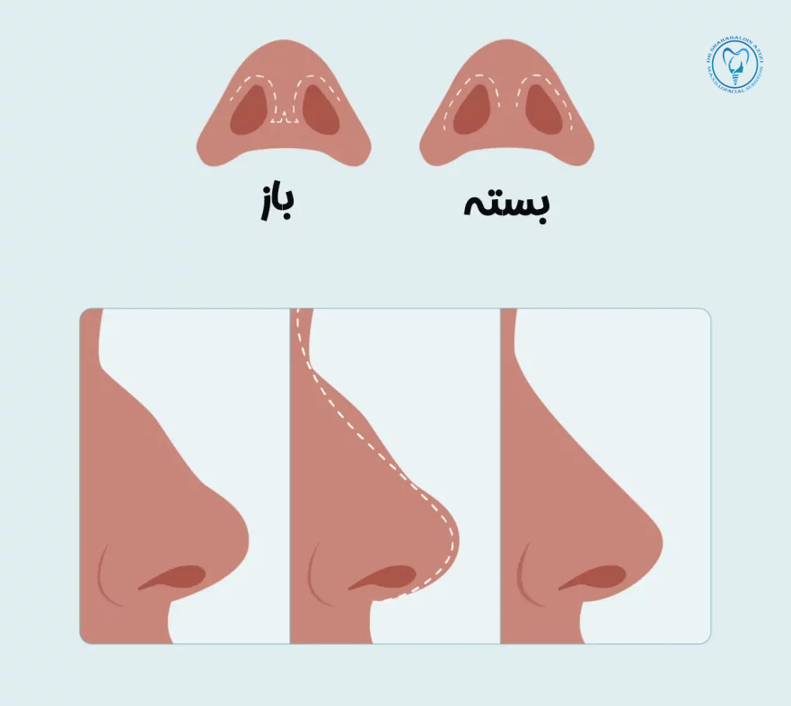 تفاوت جراحی بینی باز و بسته