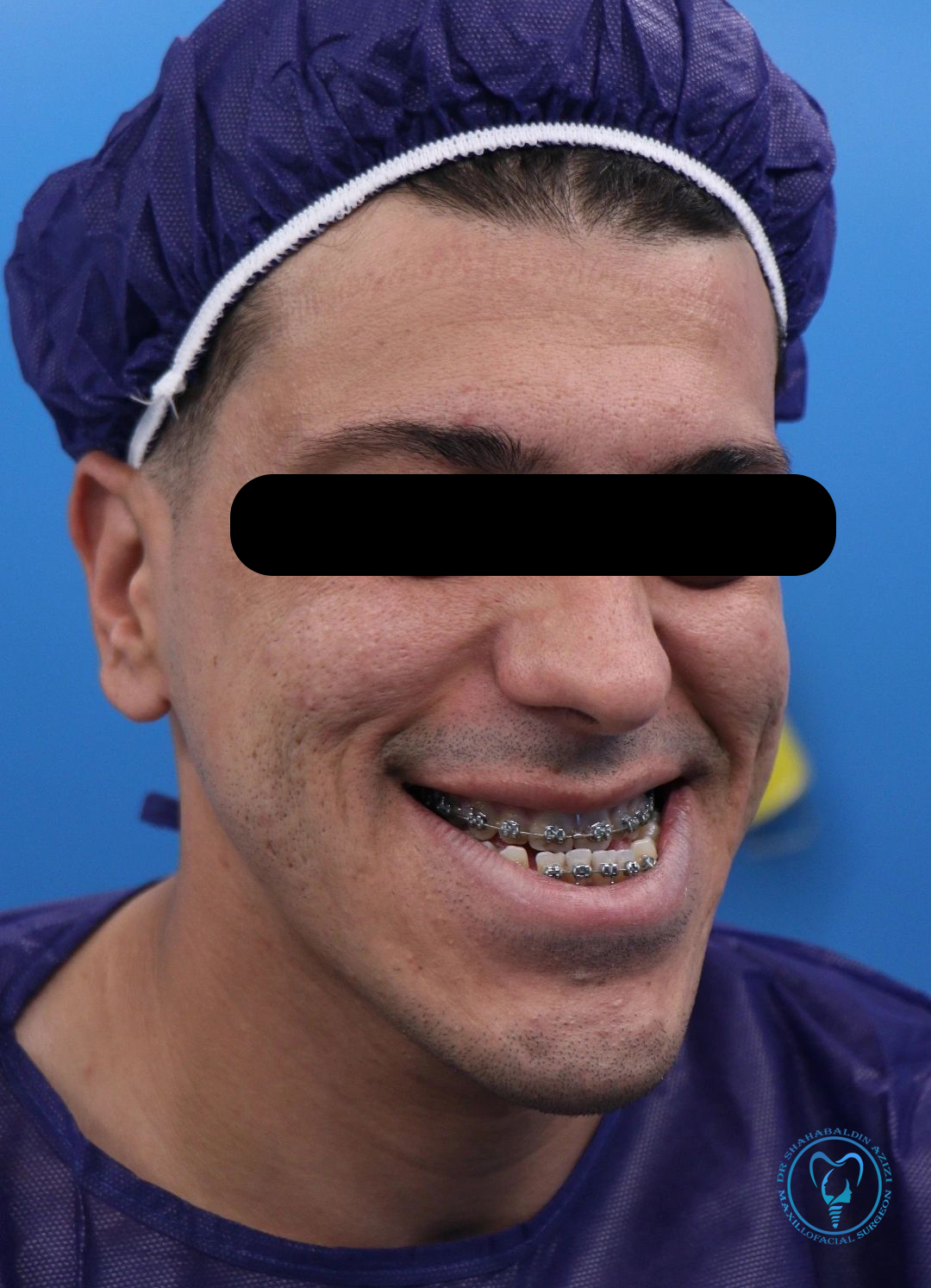 بهترین سن جراحی فک