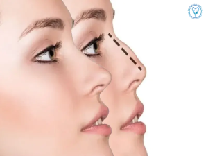 نتیجه عمل بینی استخوانی